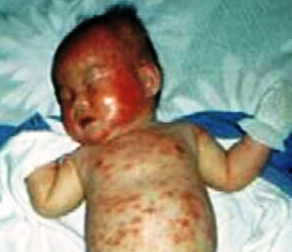 01_whole face & body covered with rash in March, 1989