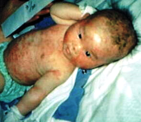 03_whole face & body covered with rash in March, 1989